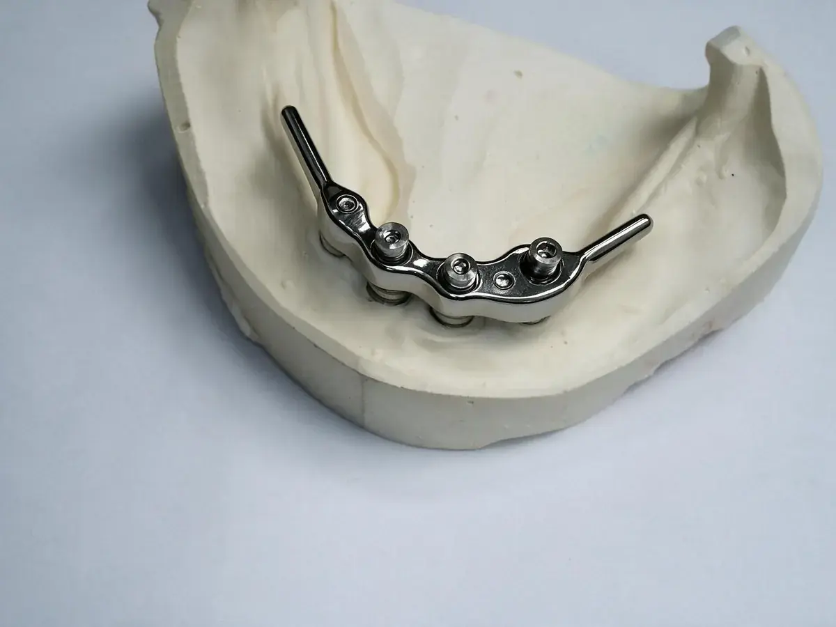Barre en titane vissée sur quatre implants, posée sur un modèle en plâtre