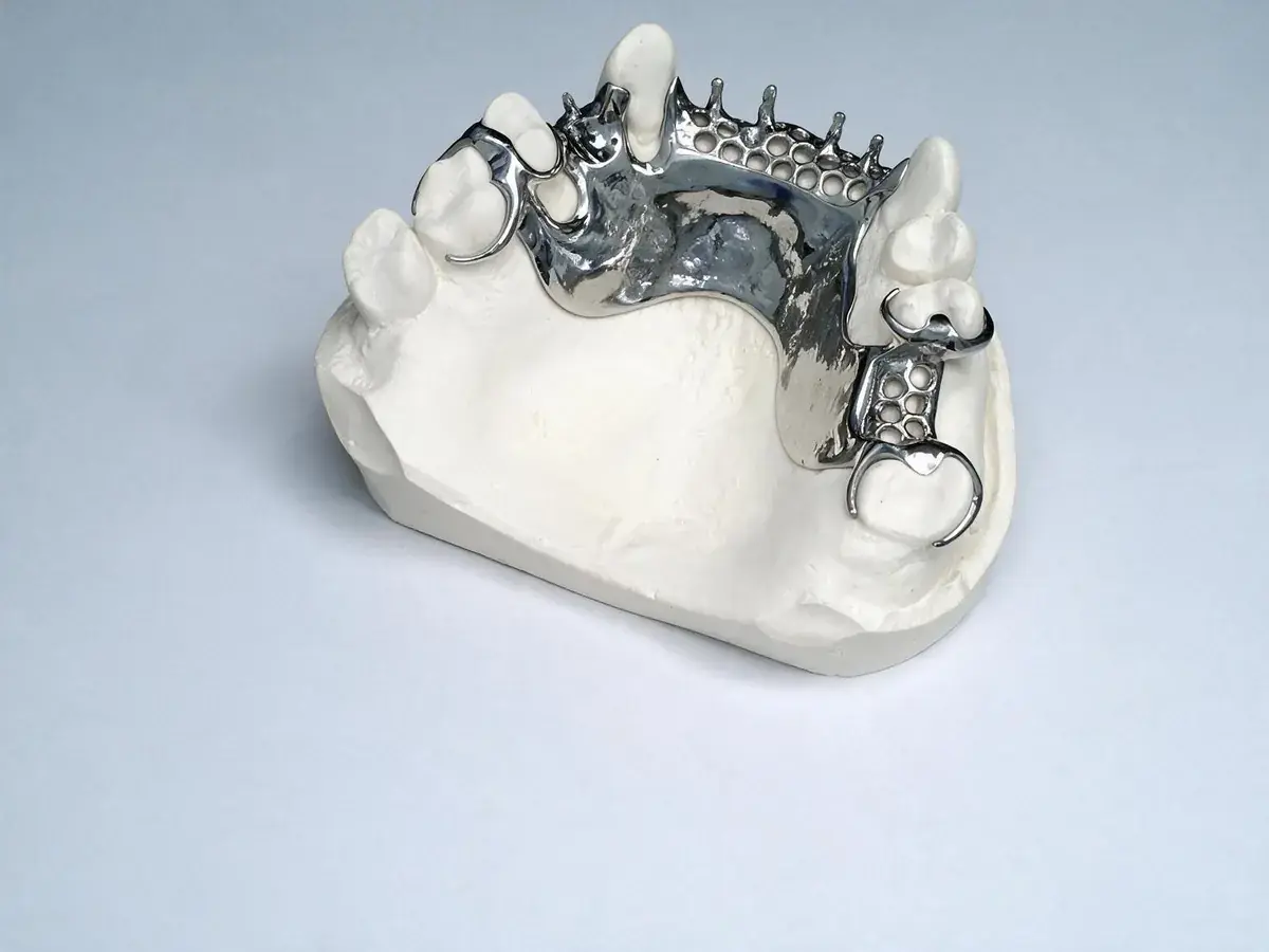 Châssis métallique de prothèse partielle en cobalt-chrome posé sur un modèle en plâtre, avec crochets et grilles de rétention